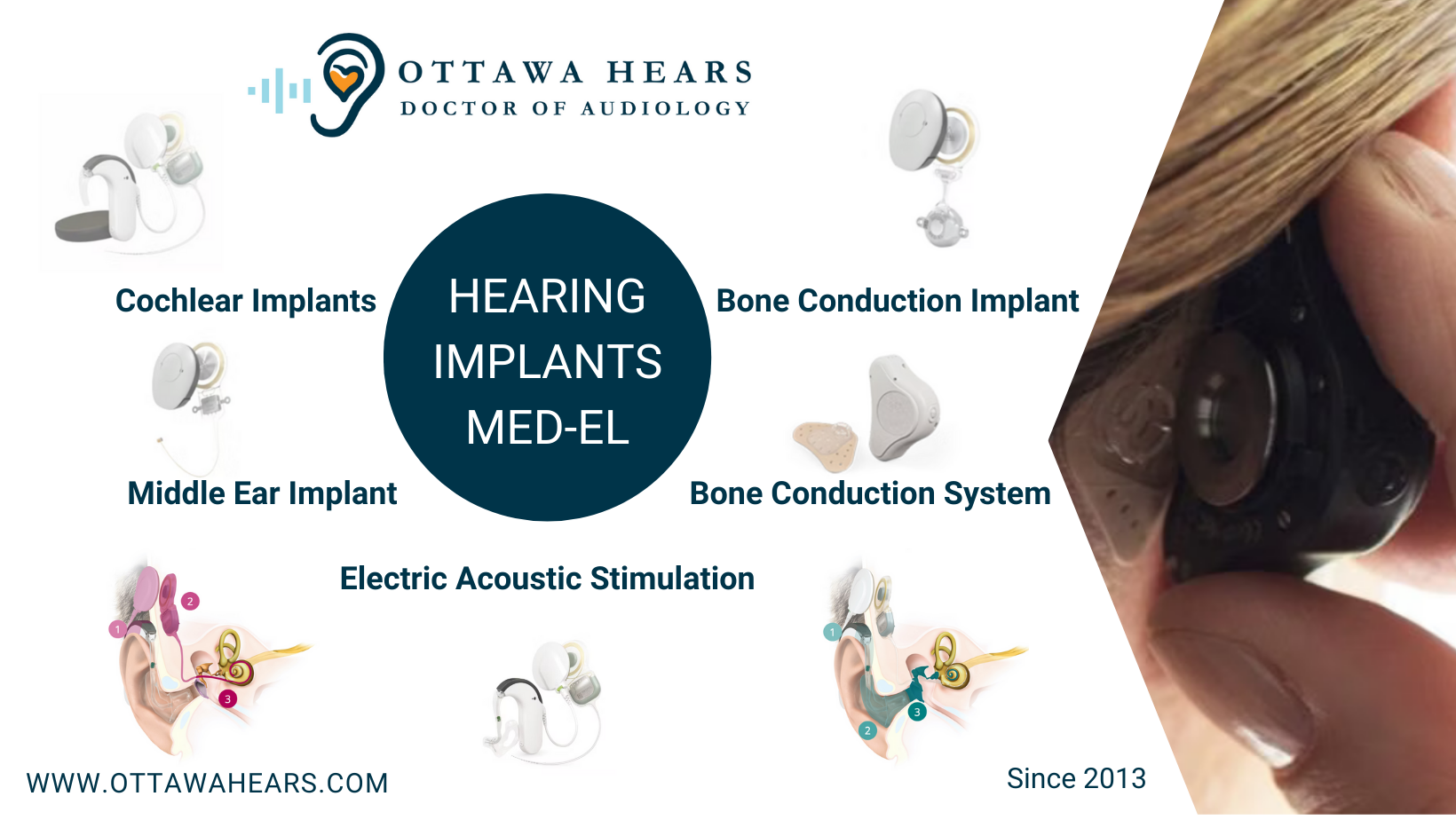 Beyond Hearing Aids: A Solution for All, Hearing Implants