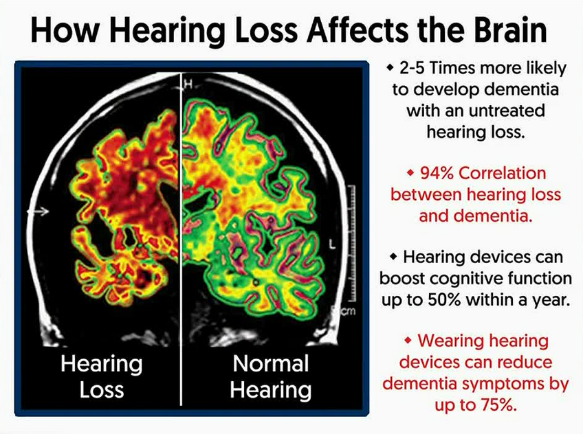 Link between hearing loss and dementia